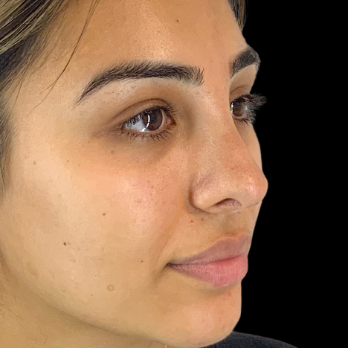 ethnic-rhinoplasty-after